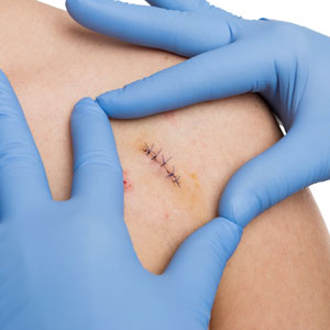 Sutures