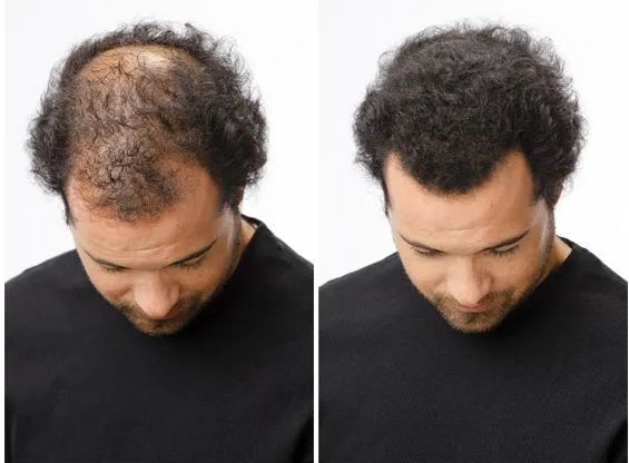 Fibres capillaires densifiantes pour calvitie et alopecie