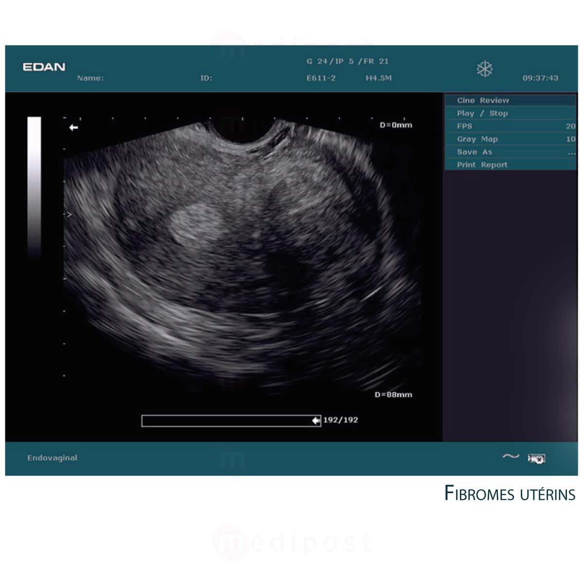 Echographe Edan DUS 60 sans sonde M05