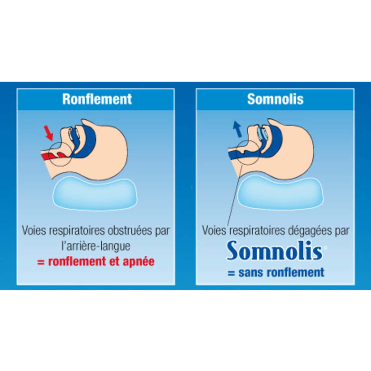 SOMNOLIS Orthese avancement mandibulaire M03