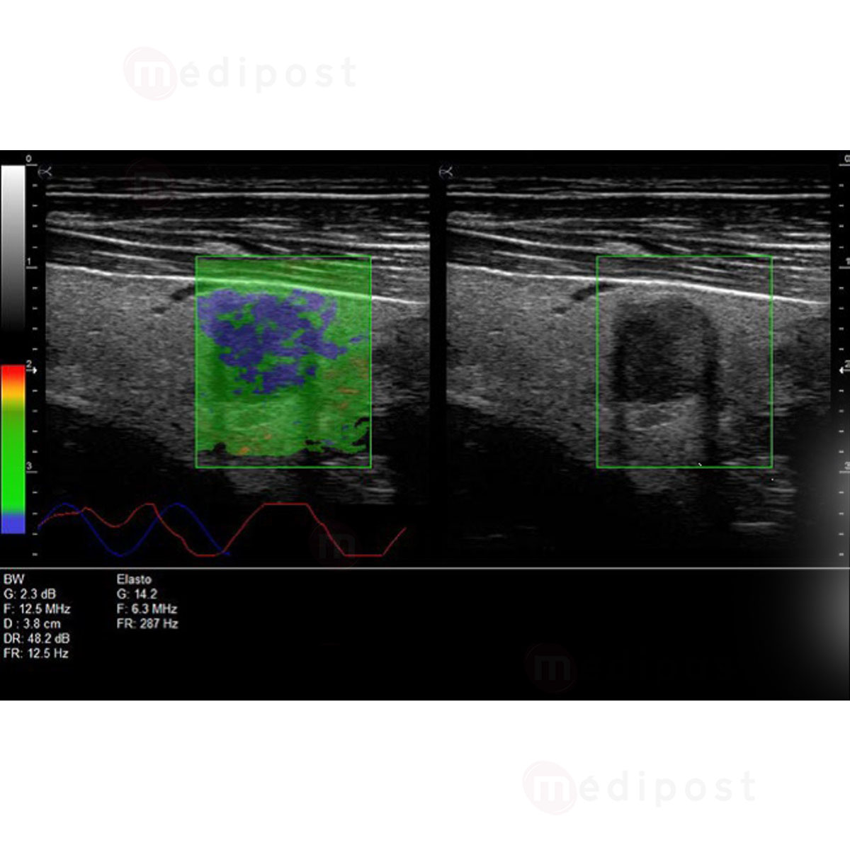 ORCHEOLITE Echographe HD Sonoscanner Orcheo Lite M9