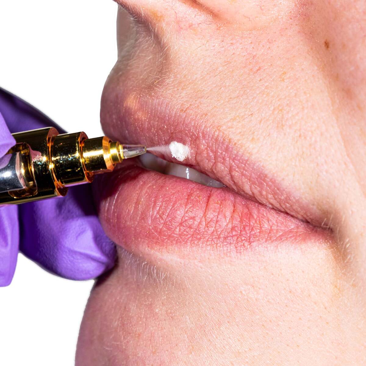 cryoalfa super derm s liquid freezing M04