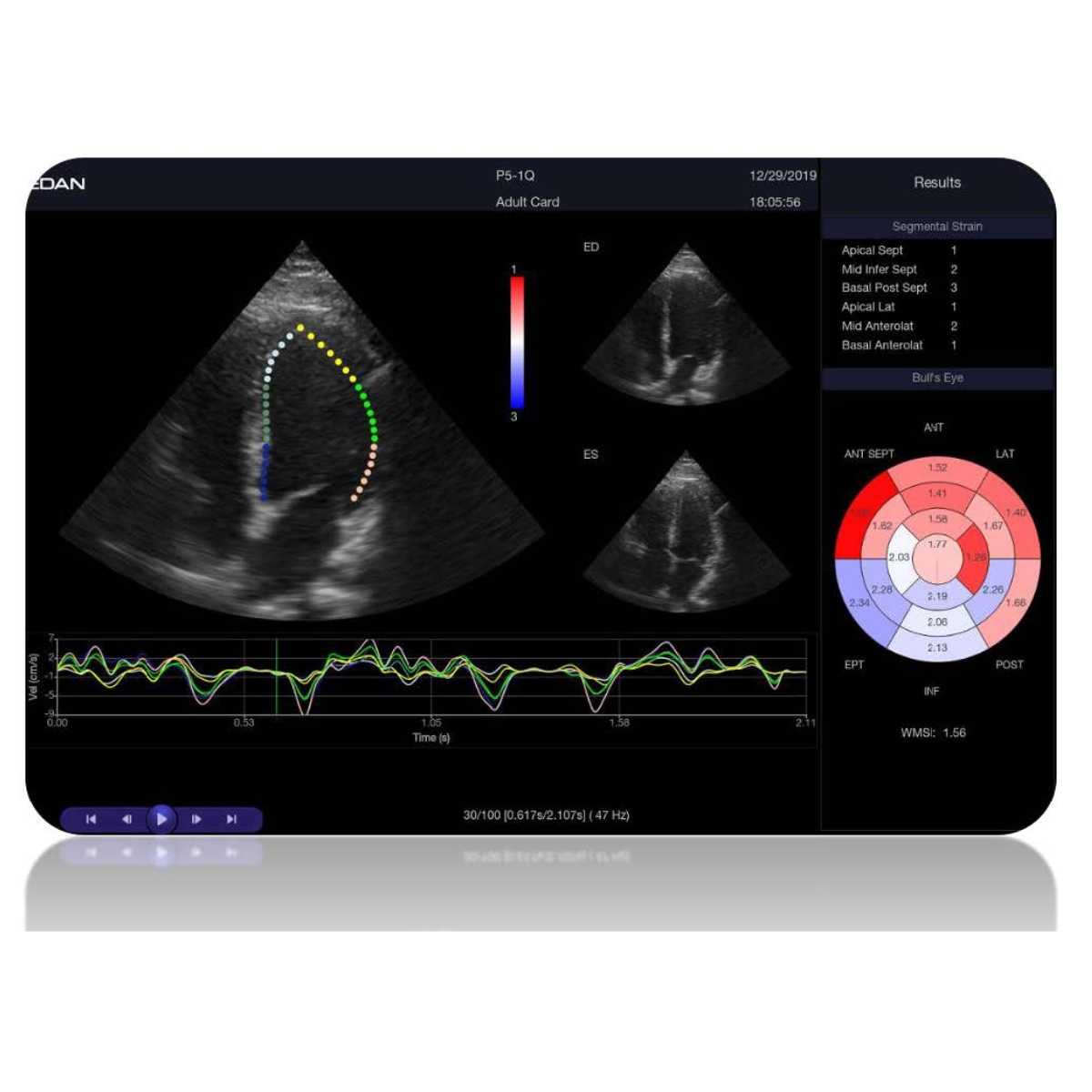 Echographe Edan Acclarix LX9 sans sonde M06