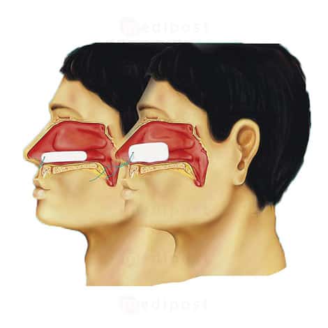 Raucocel steriele neustampon voor epistaxis