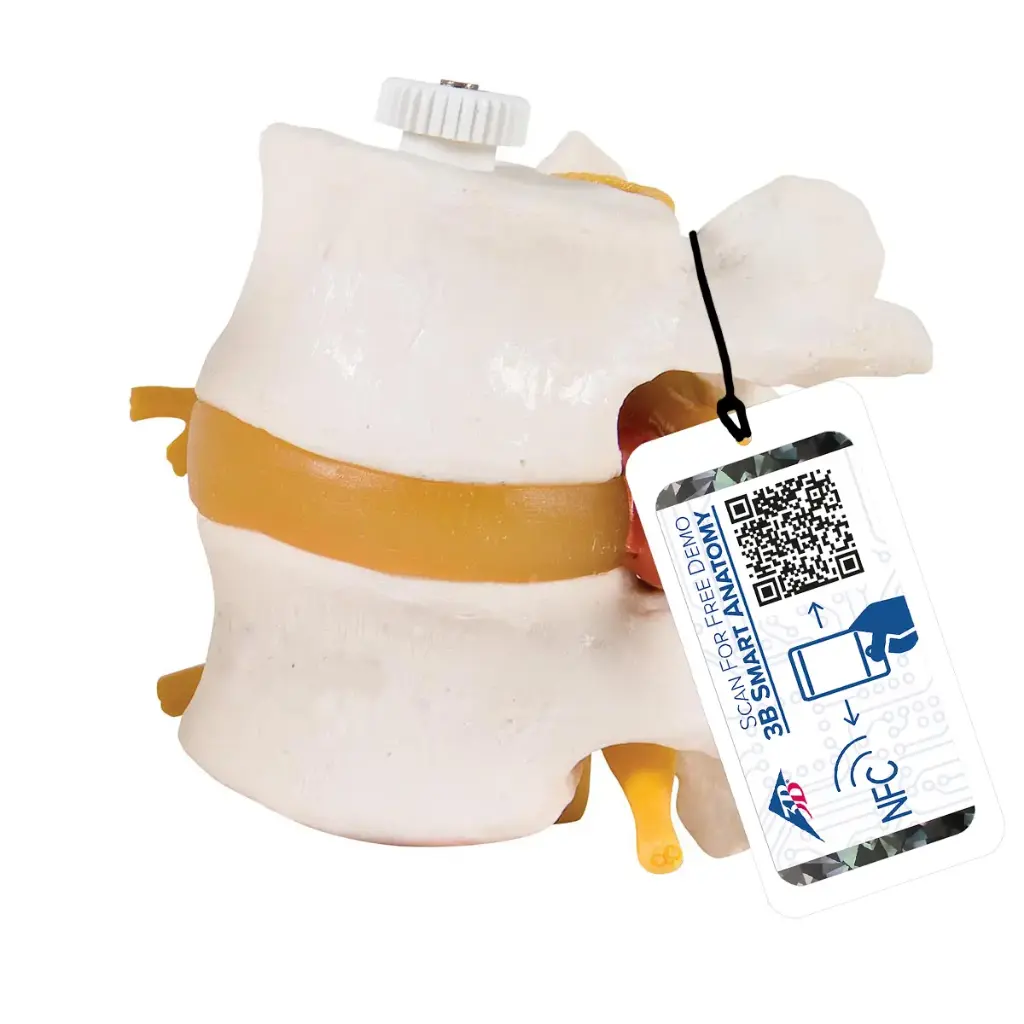 2 vertèbres lombaires 3B Scientific® avec prolapsus du disque intervertébral 