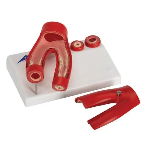 Modèle d'athérosclérose avec coupe transversale de l'artère 3B Scientific®
