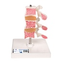 Modèle de luxe d'ostéoporose 3B Scientific®