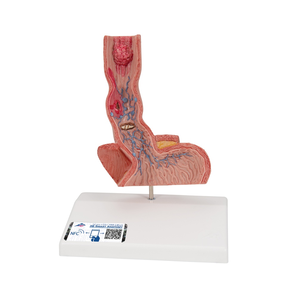 Maladies de l'œsophage 3B Scientific®
