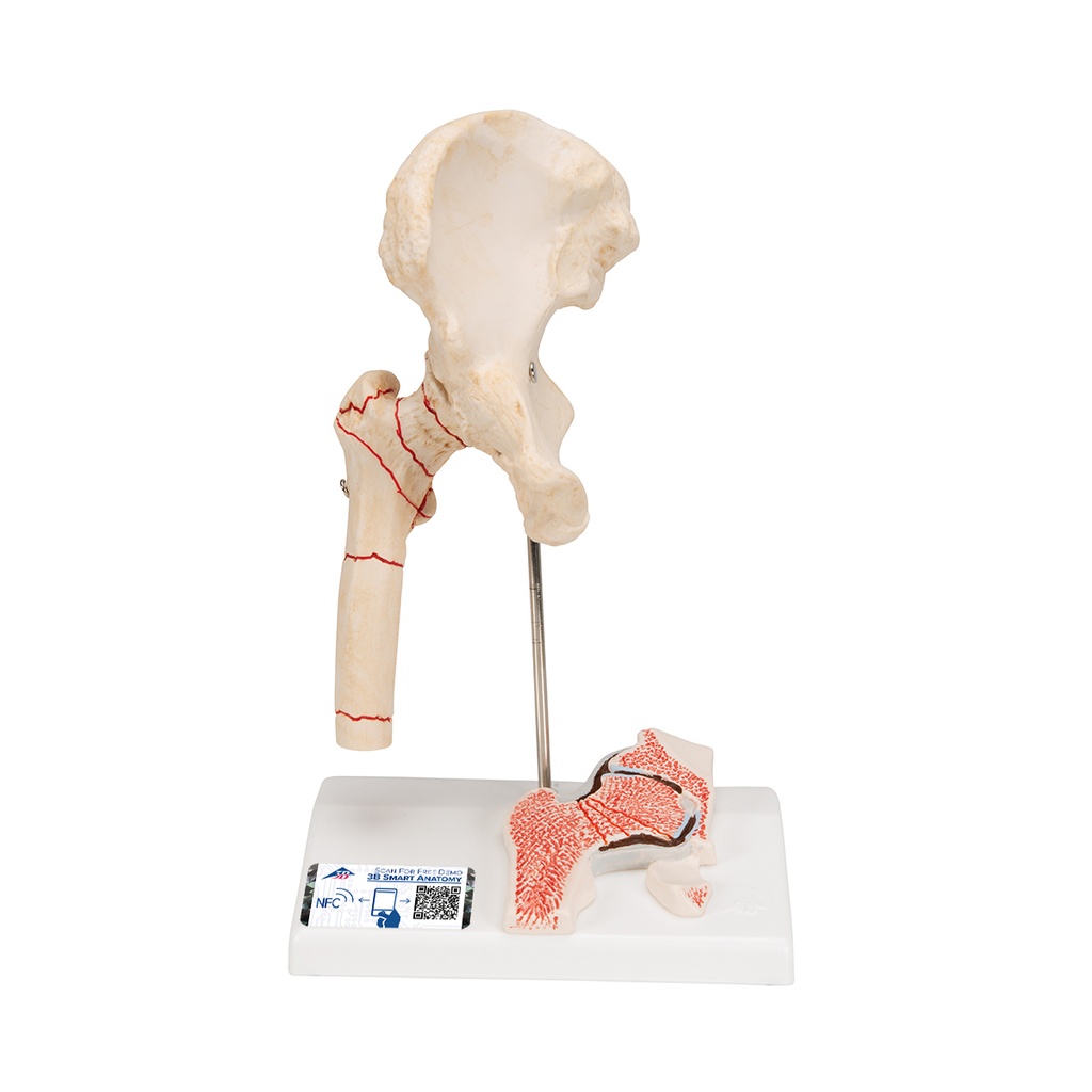 Fracture fémorale 3B Scientific®