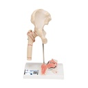 Fracture fémorale 3B Scientific®