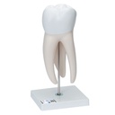 Molaire géante avec caries dentaires 3B Scientific®