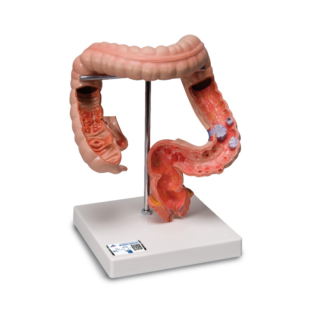 Maladies intestinales 3B Scientific®