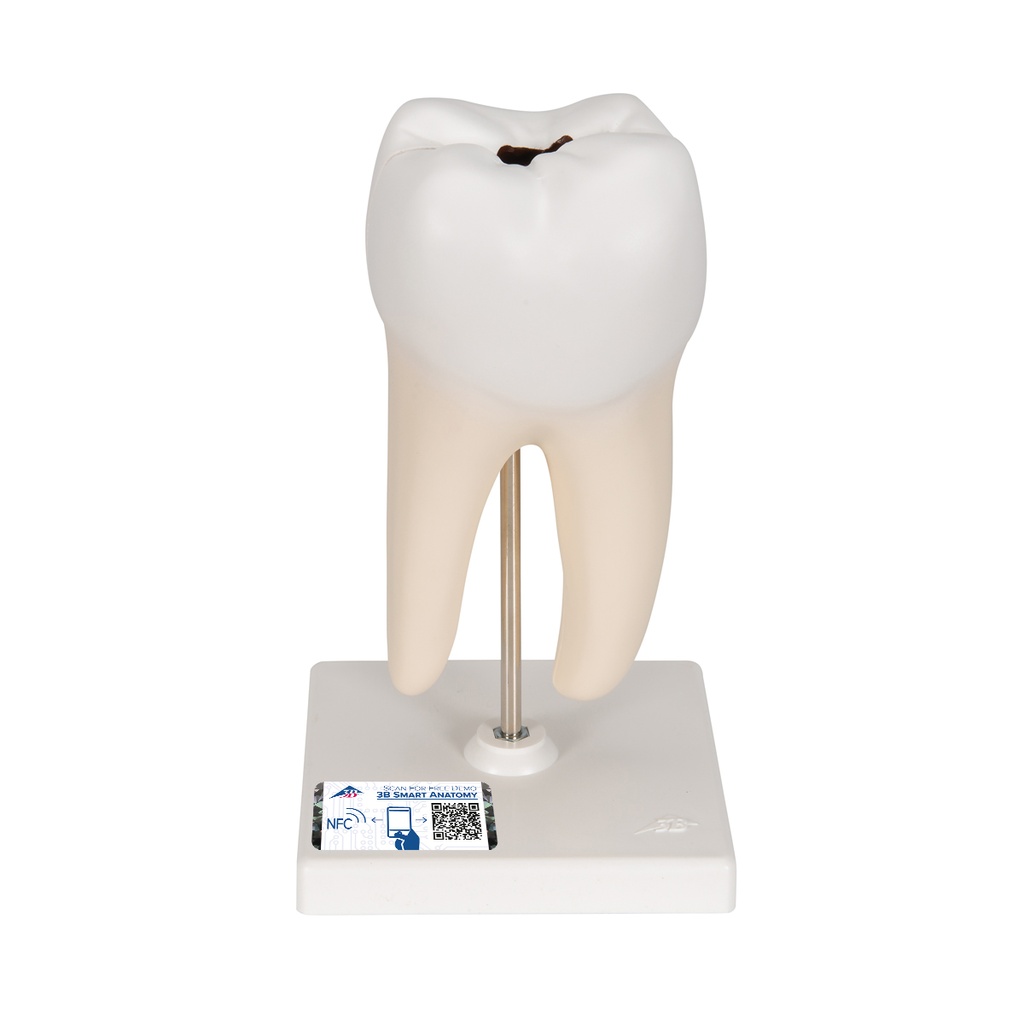 Molaire inférieure à double racine avec caries 3B Scientific®