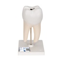 Molaire inférieure à double racine avec caries 3B Scientific®