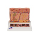Cancer de la peau - Modèle 3B Scientific®