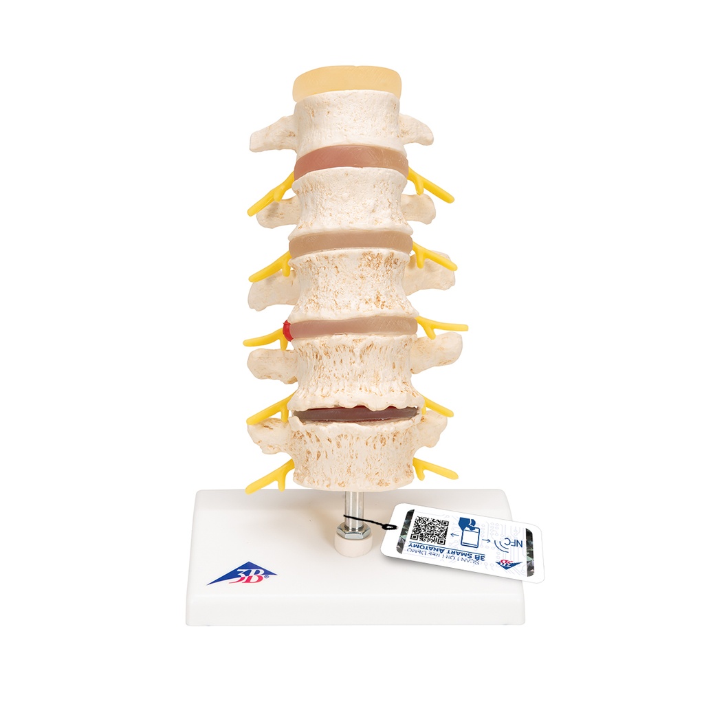 Stades de la hernie discale 3B Scientific®