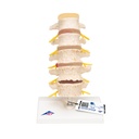 Stades de la hernie discale 3B Scientific®