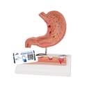 Estomac avec ulcères 3B Scientific®