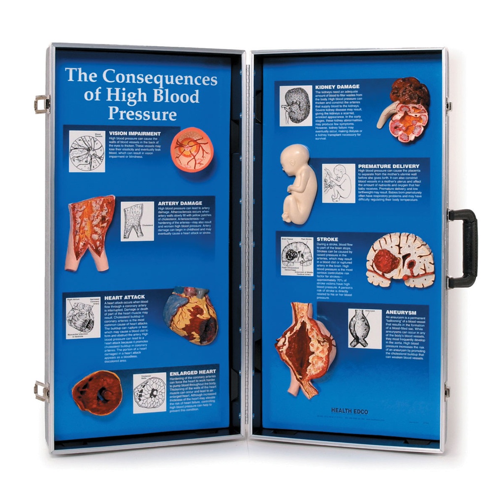 Conséquences de l'hypertension artérielle - Affichage 3D 3B Scientific®
