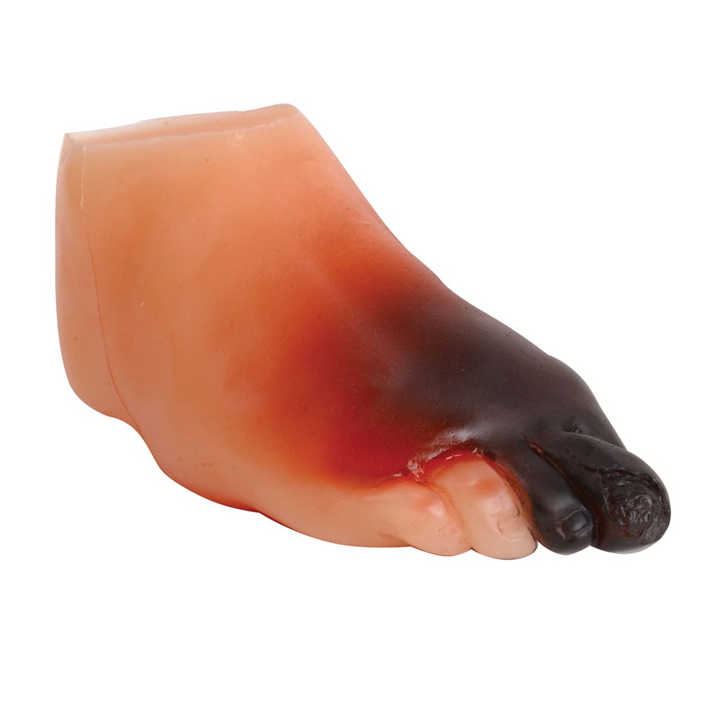 Modèle de pied diabétique sévère 3B Scientific®