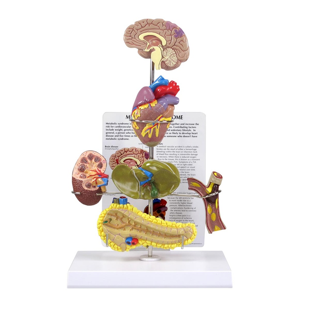 Modèle de syndrome métabolique 3B Scientific®