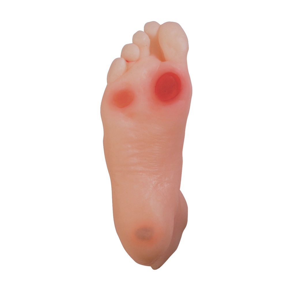 Modèle de pied diabétique 3B Scientific®